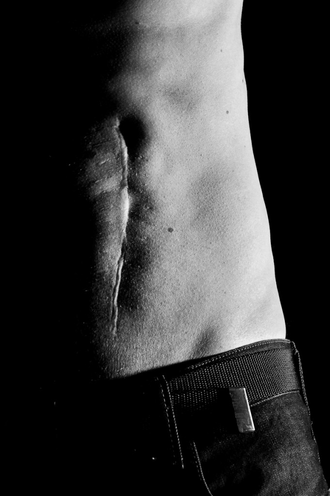Scar